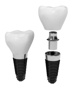 implant