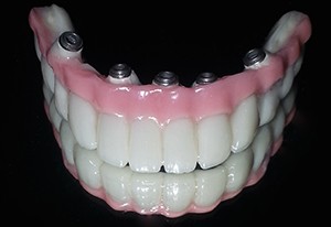 implant 2